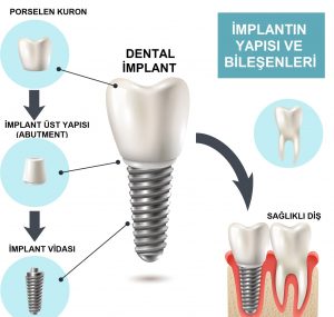 implantın yapısı ve bileşenleri