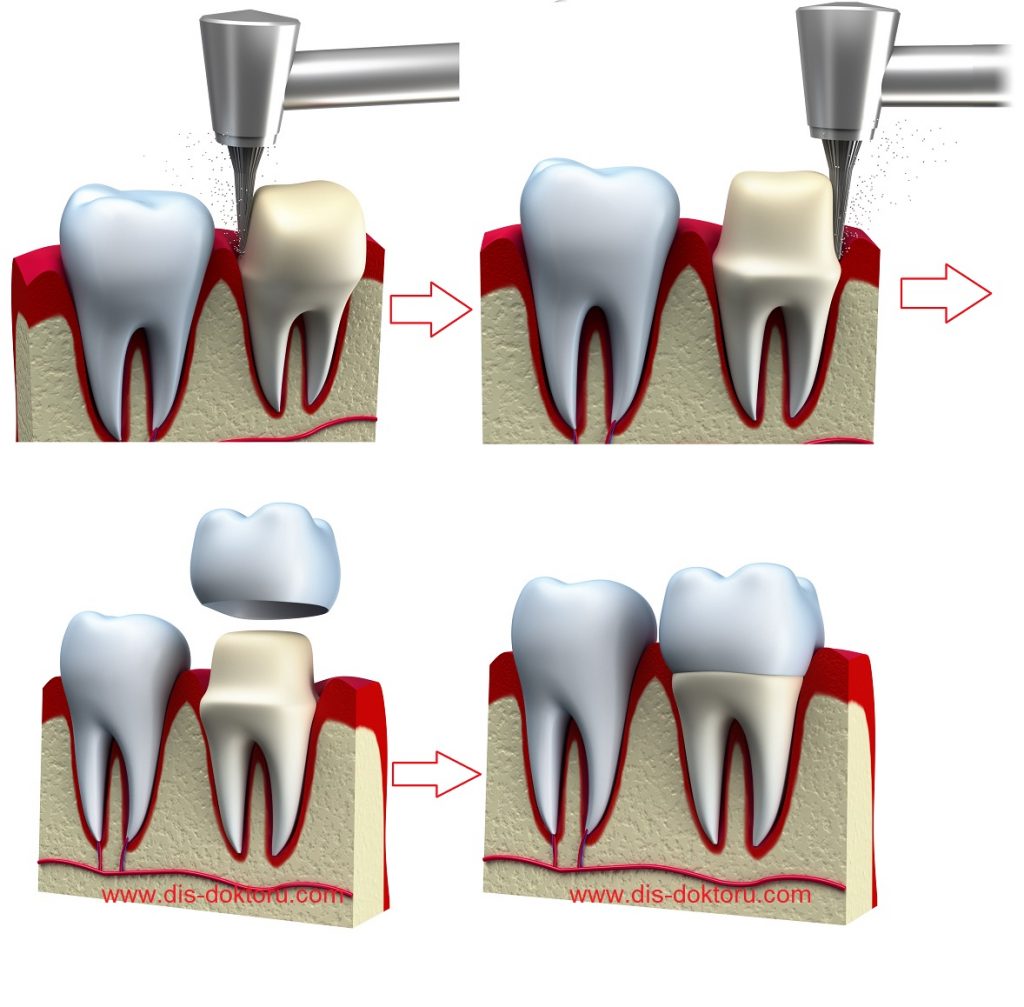 Diş Kaplaması (Kron) Yapım Aşamaları