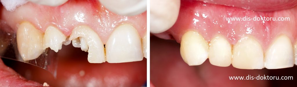 Estetik Diş Dolgusu (Öncesi - Sonrası)| Gebze
