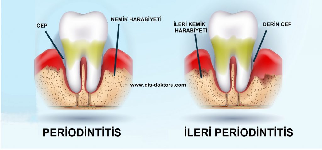 Dişeti Hastalıkları Tedavisi (Periodintitis)