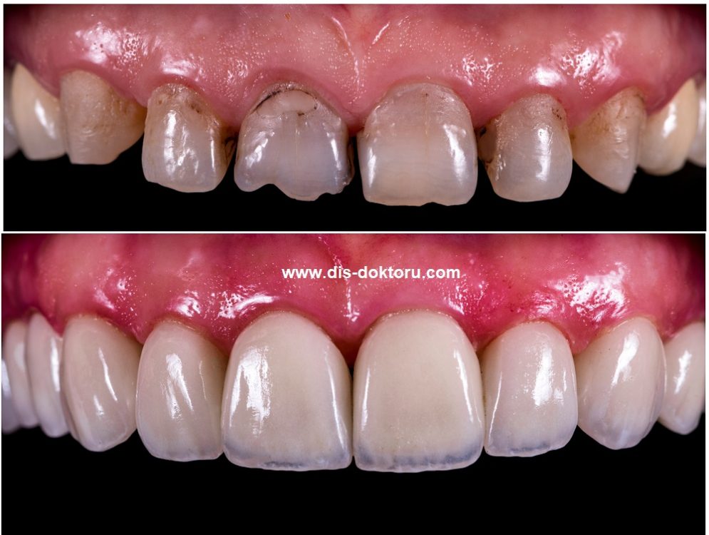 Zirkonyum destekli porselen diş kaplama
